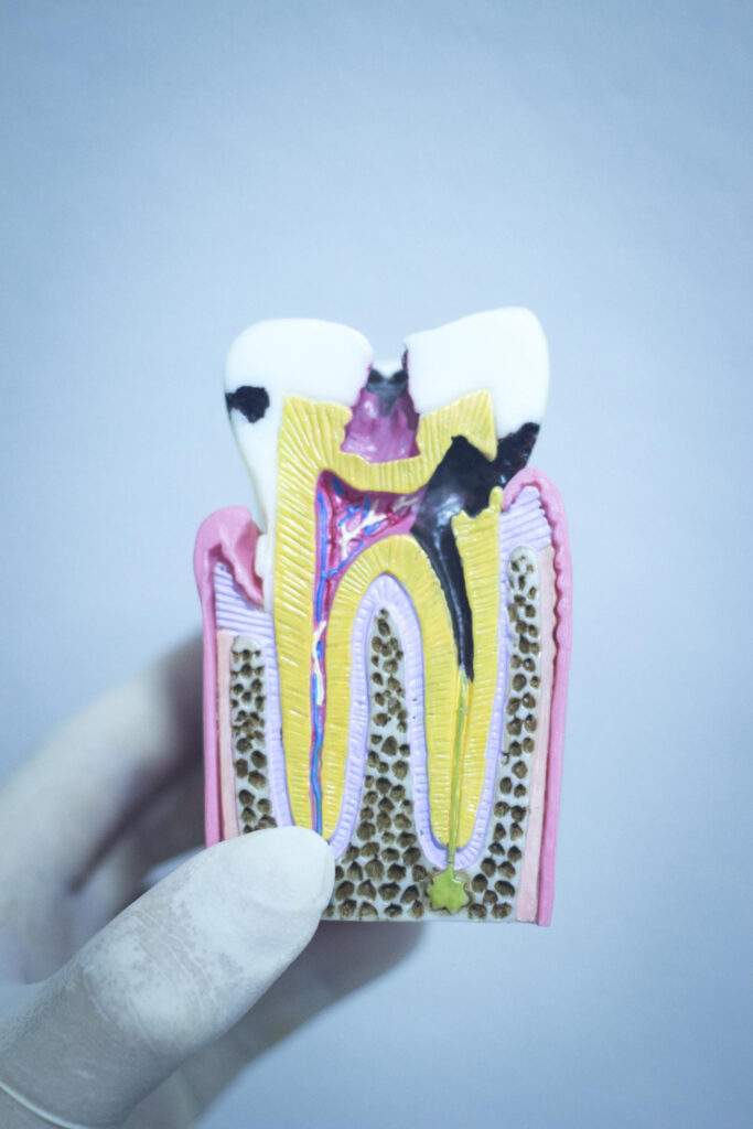 Endodoncia en Chamartín