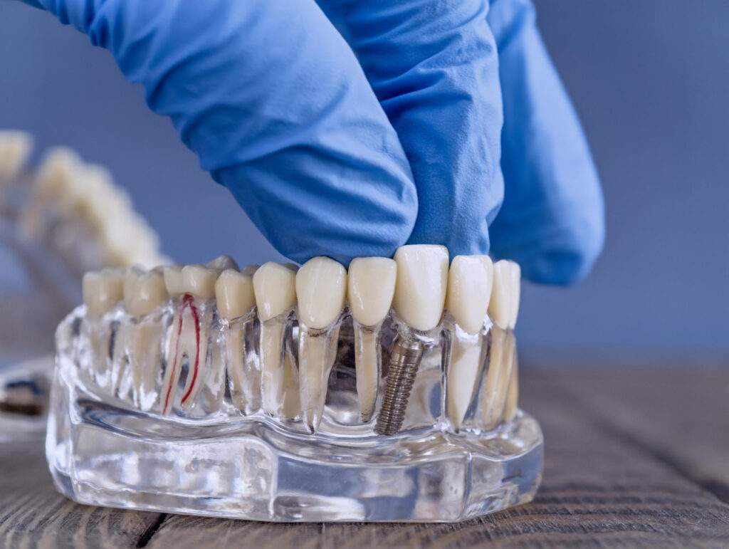 Implantes dentales: cuándo merecen la pena y qué debes saber antes de empezar el tratamiento